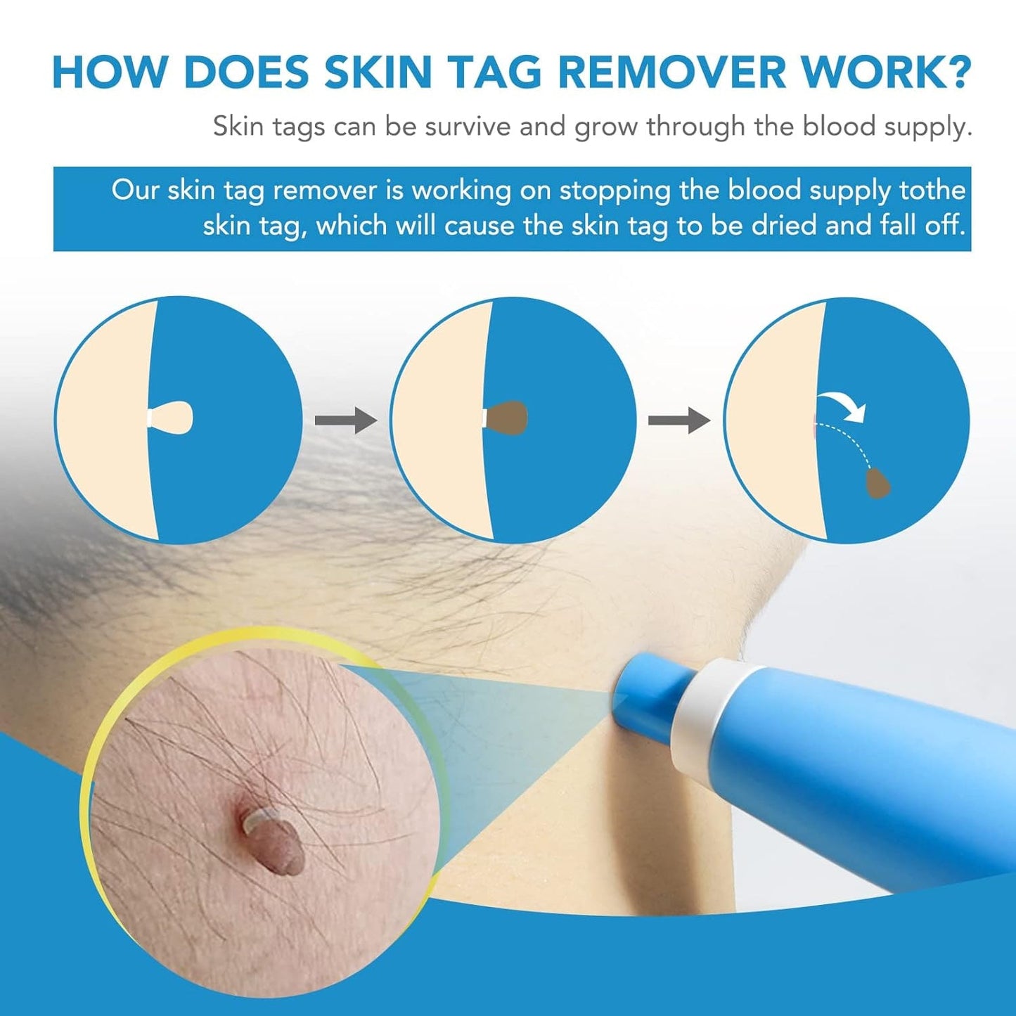 2-in-1 Skin Tag Remover Kit for Micro to Large Tags (2–8 mm) | Safe, Painless Wart & Skin Tag Removal Device for Home Use (1 Set)
