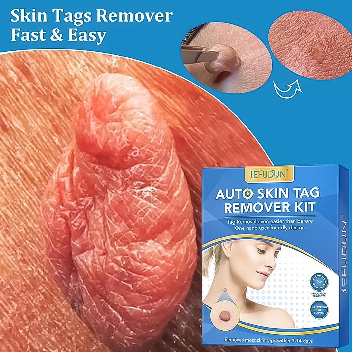2-in-1 Skin Tag Remover Kit for Micro to Large Tags (2–8 mm) | Safe, Painless Wart & Skin Tag Removal Device for Home Use (1 Set)